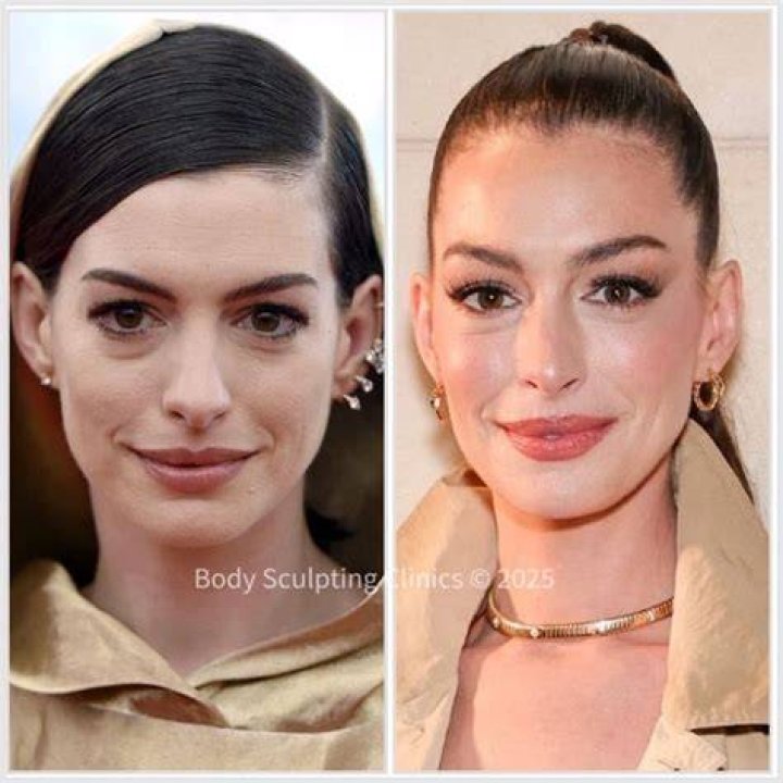 Anne Hathaway's Transformation: Botox Surgery Unveiled?
