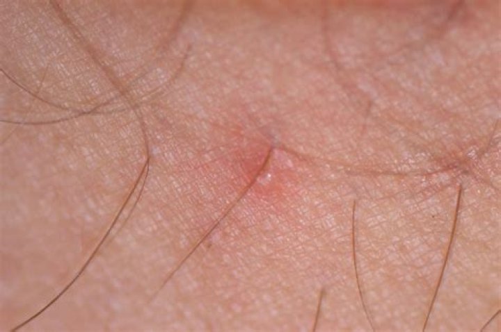 Can Chiggers Burrow Beneath Your Skin?