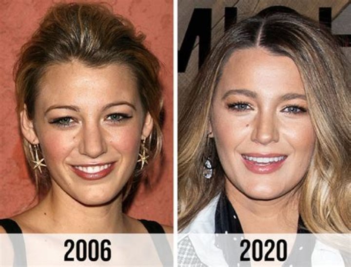 Did Blake Lively Have Surgery? Unpacking the Transformation of a Hollywood Icon