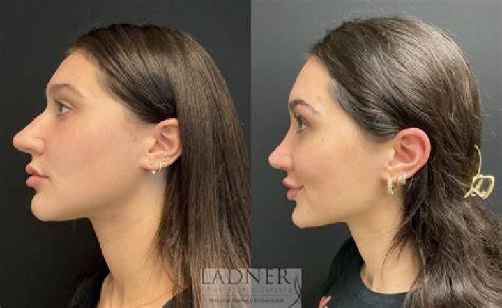 Did Rick Ness Get A Nose Job? Expert Analysis Of Rhinoplasty Rumors