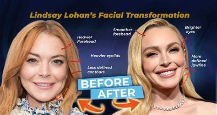 Lindsay Lohan's Plastic Surgery Journey: Unveiling Truths And Reflections