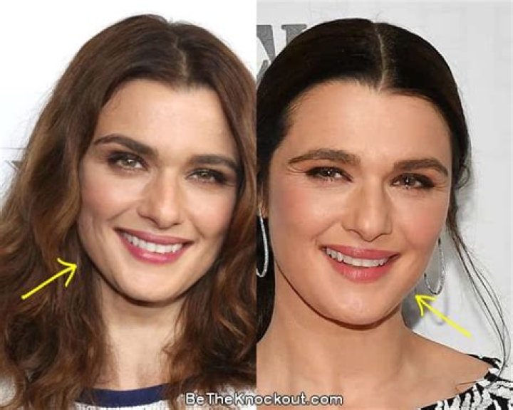 Rachel Weisz Surgery: Unveiling Hidden Truths