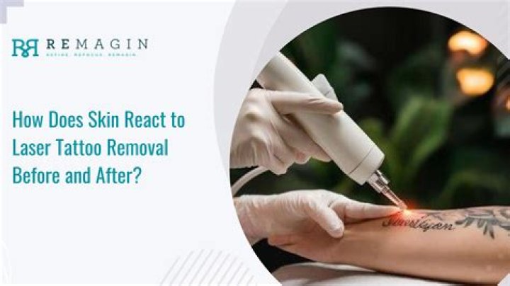 Tattoo Before SurgeryRisks, Benefits, And Expert Advice