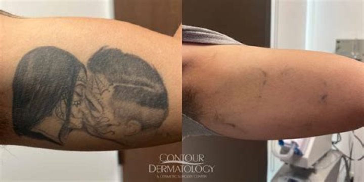 Tattoos Before Surgery Insights You Need To Know