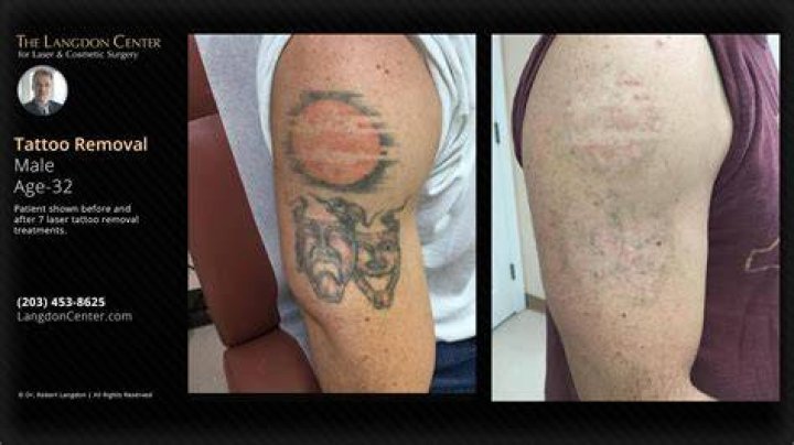 Uncover The Truth: Tattoos Before Surgery