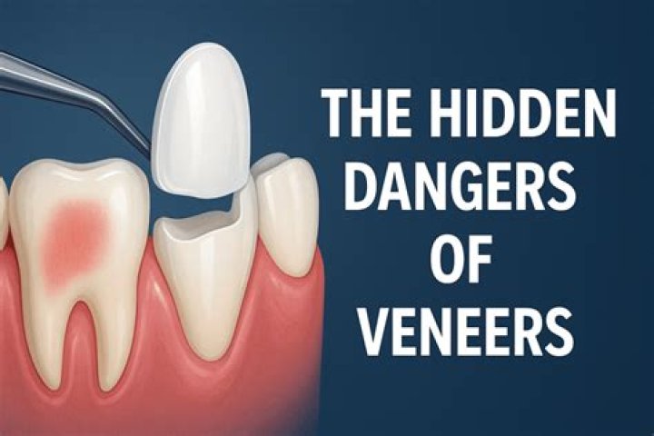 Uncovering the Power of Veneers