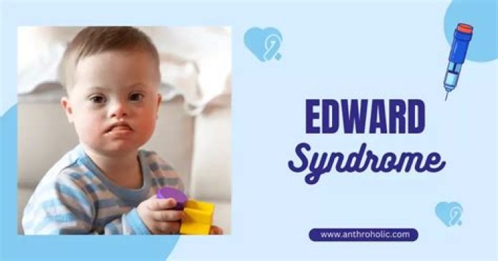 Understanding Edward Bluemel Syndrome: Causes, Symptoms, and Treatment Options