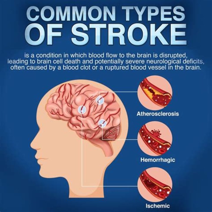 Understanding Harry Connick's Stroke: Causes, Effects, and Recovery Journey