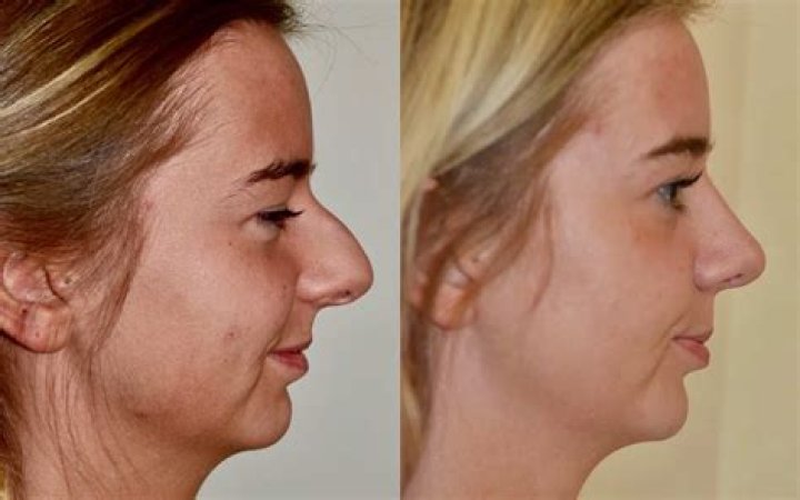 Unlocking The Secrets Of Cosmetic Rhinoplasty