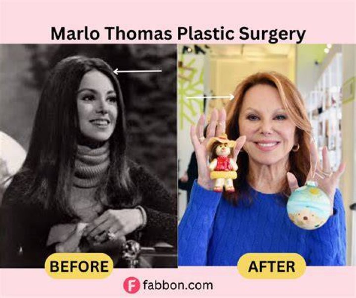 Unveiling The Secrets Of Marlo Thomas's Cosmetic Journey: Insights And Discoveries